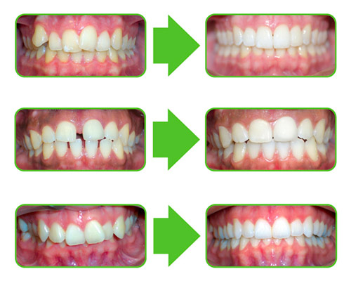 What To Expect Before And After Treatment: Clear Invisible Braces